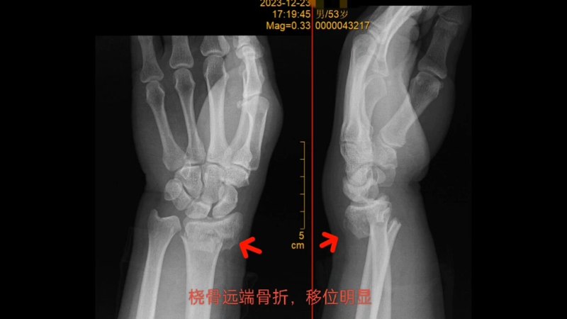 ［骨折］科普第19集：桡骨远端骨折，门诊比较常见，如发生明显移位，保守治疗欠佳，可选择手术。