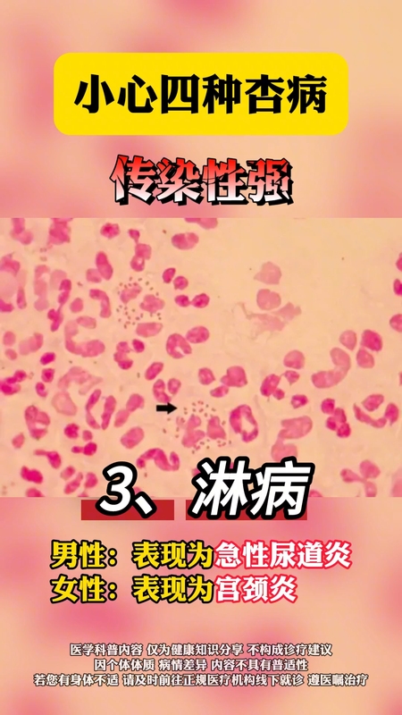 性病防治