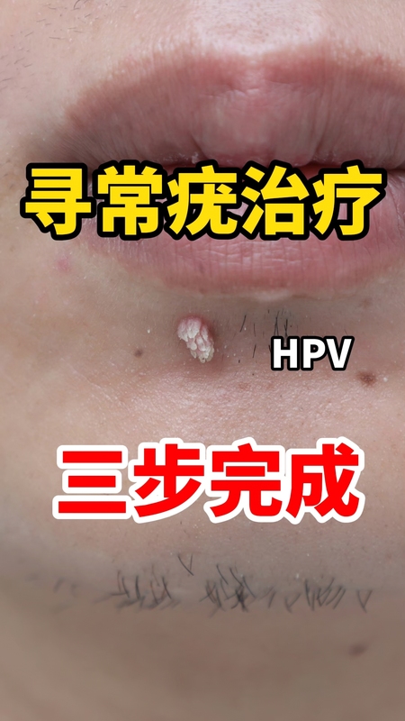 寻常疣治疗三步完成