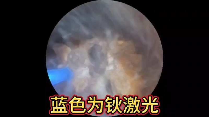 肾结石微创治疗！