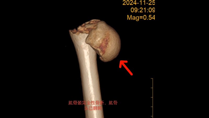 ［骨折］科普第24集:肱骨近端骨折，肱骨头跑位了，怎么办？