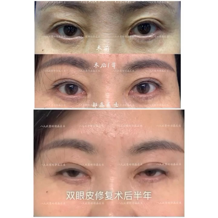 双眼皮修复，改善上眼皮的松弛