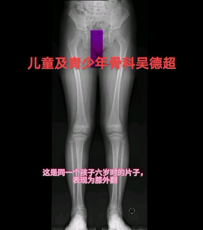 儿童膝内翻膝外翻，儿童腿型发育＃医生日常 ＃医学科普 ＃腿型  ＃膝外翻 ＃膝内翻
