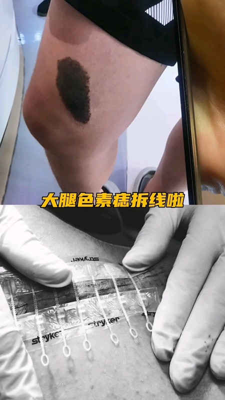 做好这三点，术后少留疤！