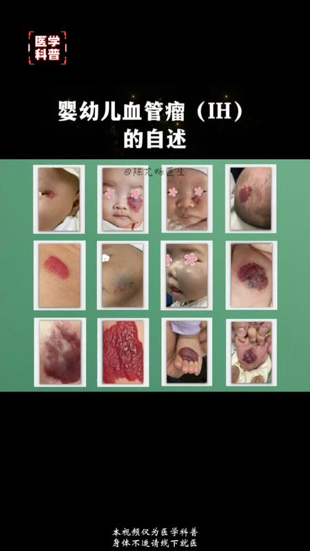 婴幼儿血管瘤的自述
