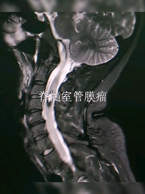 背部疼痛，检查发现脊髓髓内肿瘤，切除肿瘤后，肢体活动良好，手指尖稍麻木…