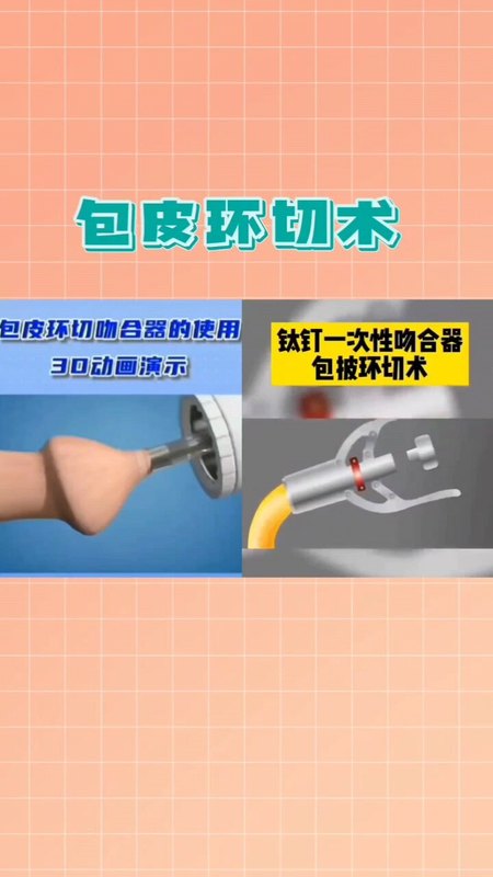 包皮环切术1
