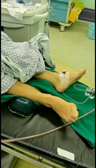 帕金森病患者会出现肢体不自主动作，也叫异动，会影响患者生活。脑深部电刺激可以改善异动现象。