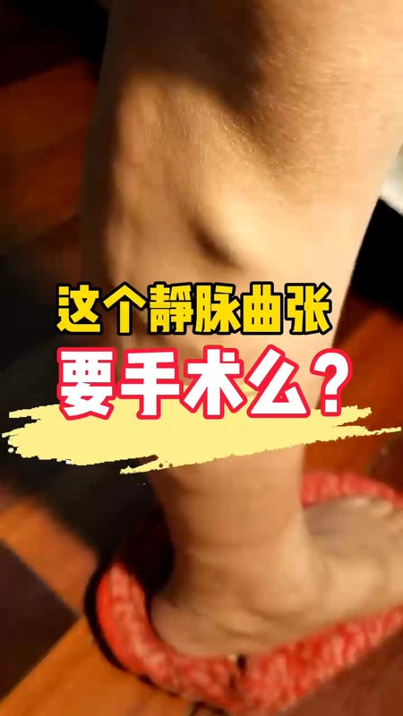 什么样的静脉曲张需要手术