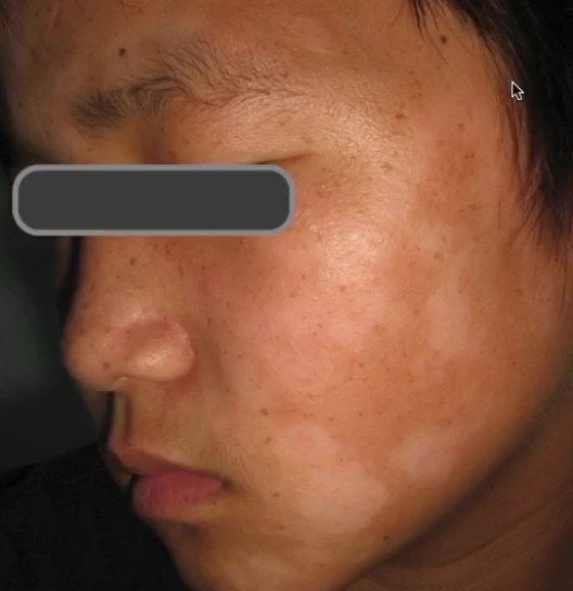 不是所有的白斑都是白癜风：白色糠疹