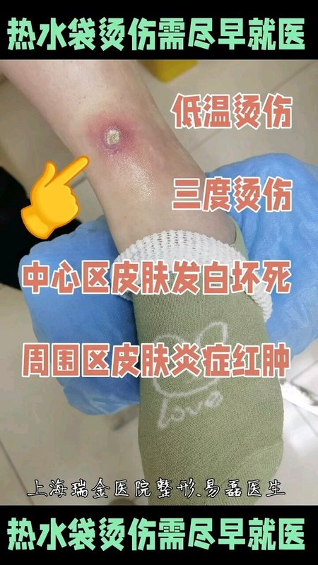 热水袋导致的低温烫伤建议尽早就医专科治疗