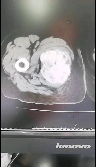 益肾补骨，局部治疗，有效控制骨巨细胞瘤（良性肿瘤，恶性表现）