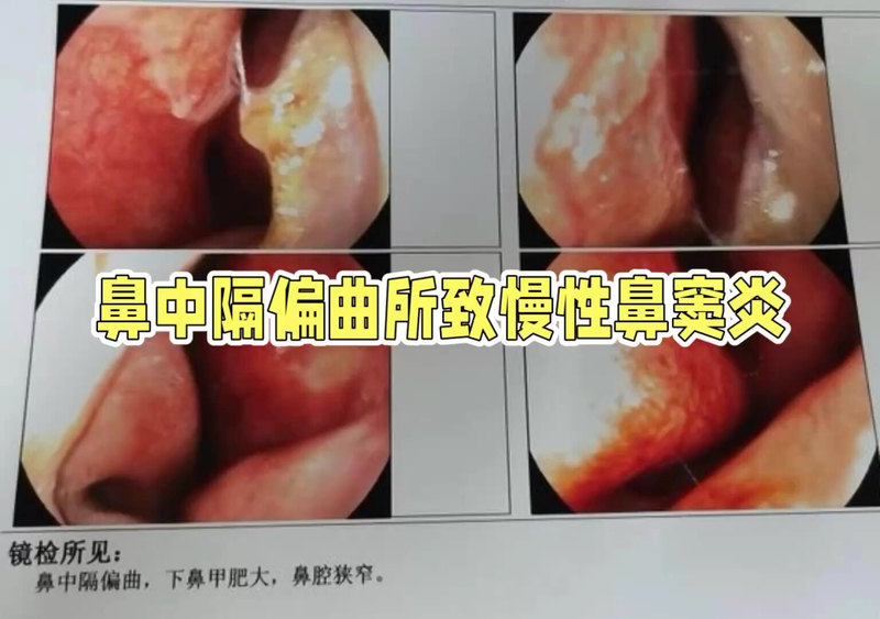 鼻中隔偏曲所致慢性鼻窦炎