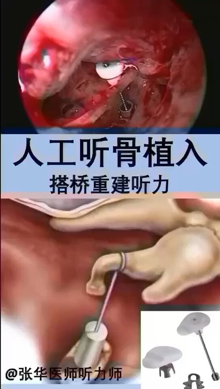 人工听骨，主要针对传导性耳聋，与针对感音神经性聋的人工耳蜗截然不同