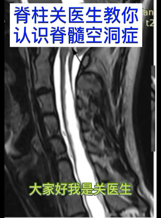 关医生教你认识脊髓空洞症