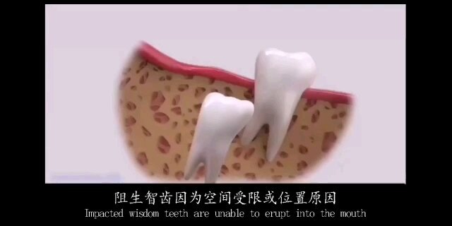 智齿需要拔除的理由和手术过程