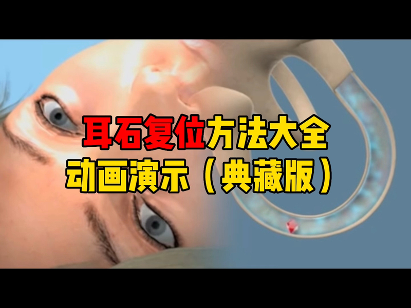 耳石复位方法大全（典藏版）