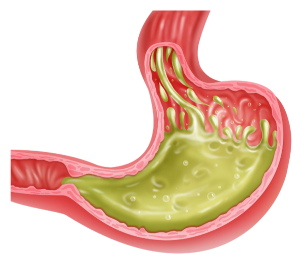 胃食管反流病- 好大夫在线