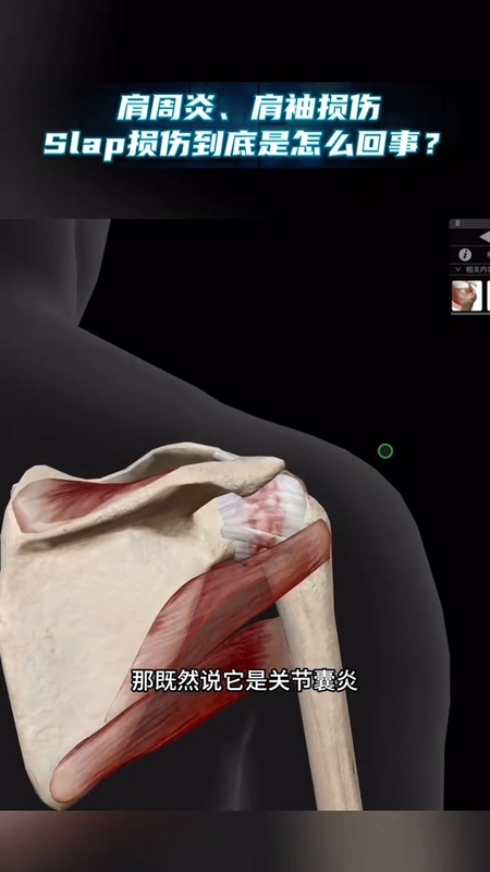 肩周炎