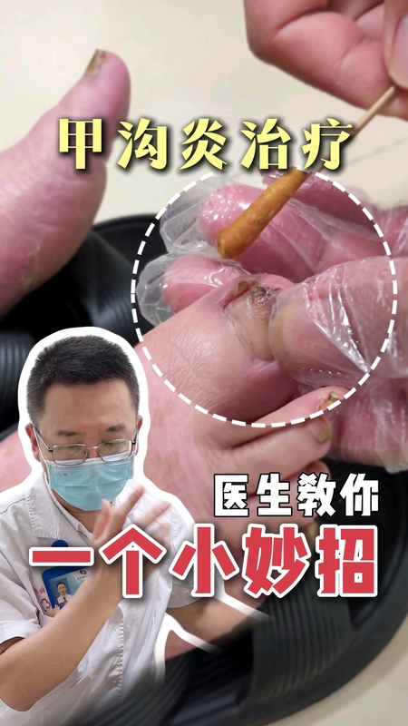 甲沟炎治疗小妙招＃健康的答案 ＃医学科普