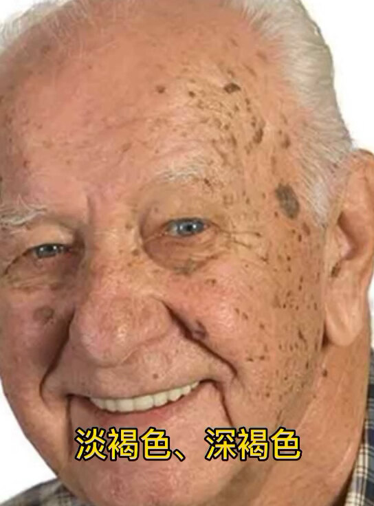 强脉冲光治疗老年斑/老年疣