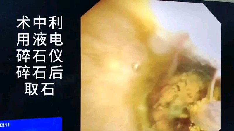 经皮经肝胆道镜取石术，手术实例一