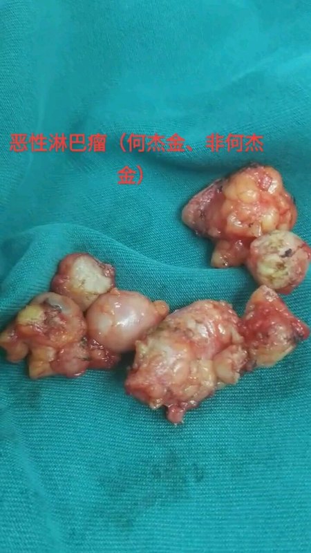 恶性淋巴瘤