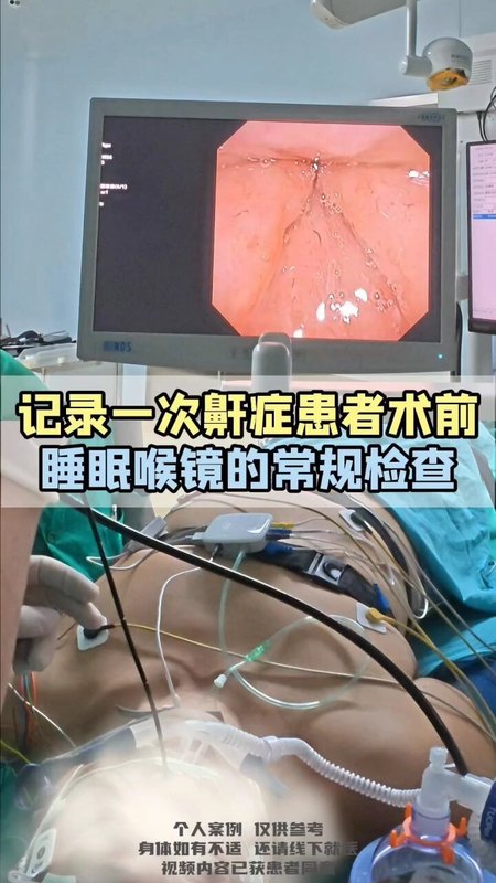你了解睡眠喉镜吗?记录一次鼾症患者术前的睡
                    眠喉镜常规检查＃医学科普＃睡眠内镜＃阻塞性睡
                    眠呼吸暂停