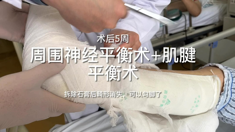 显微外科技术下的周围神经平衡术+肌腱平衡术治疗脑出血后遗症13年术前术后步态对比