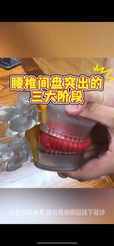腰椎间盘突出的三大阶段
