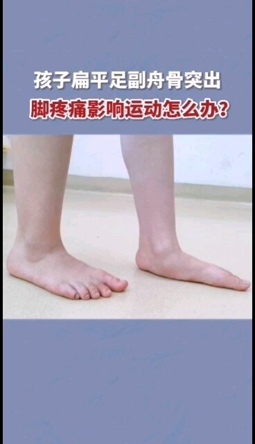 孩子扁平足副舟骨突出脚疼痛影响运动怎么办？