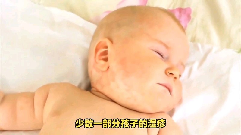 婴儿湿疹（一）