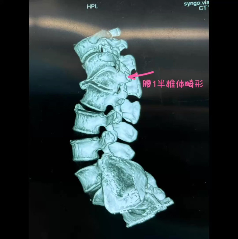 47岁女性，腰1半椎体畸形（蝴蝶椎），腰椎侧后凸畸形，手术切除半椎体，矫正畸形术，术后7天行走出院。