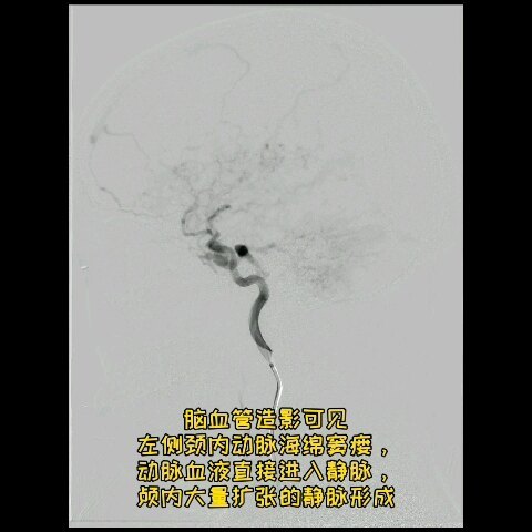 颈内动脉海绵窦瘘:眼睛红肿，耳内有轰鸣音