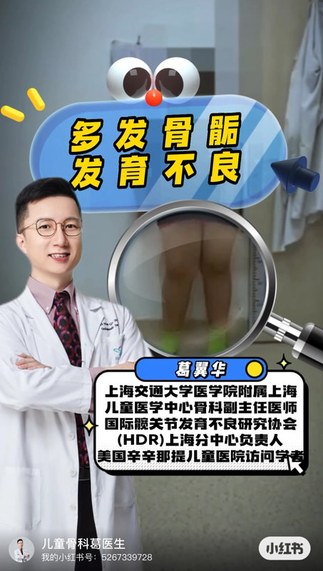 多发骨骺发育不良，X形腿，经过微创治疗，走路好多啦！