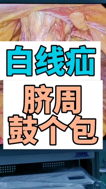 白线疝脐周鼓个包
