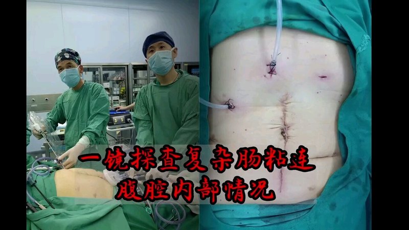 一镜探查复杂腹腔粘连，除了惊吓，还有tm的凶险！