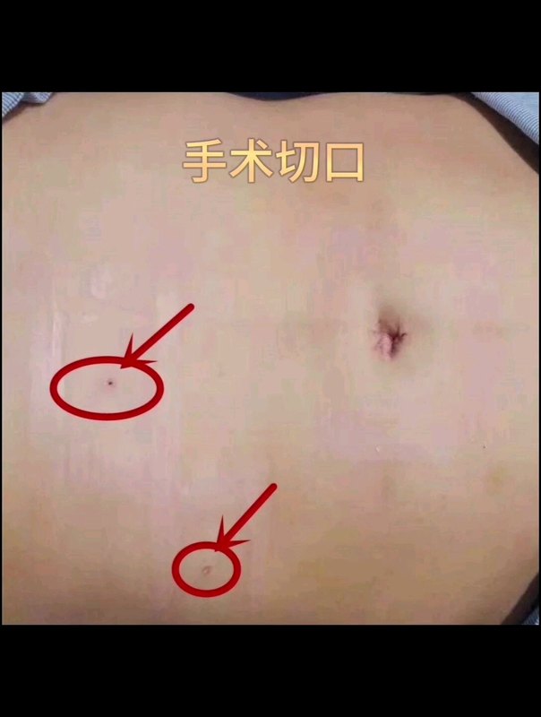 保胆取石术
