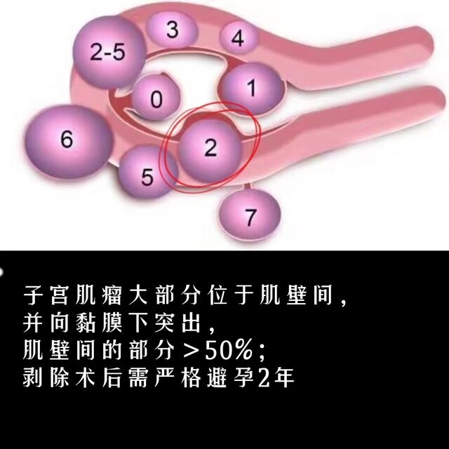 2型子宫肌瘤要备孕，选海扶啊！