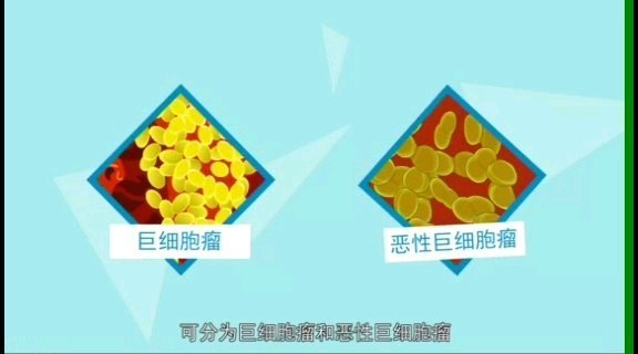 脊柱骨巨细胞瘤概况和治疗方法