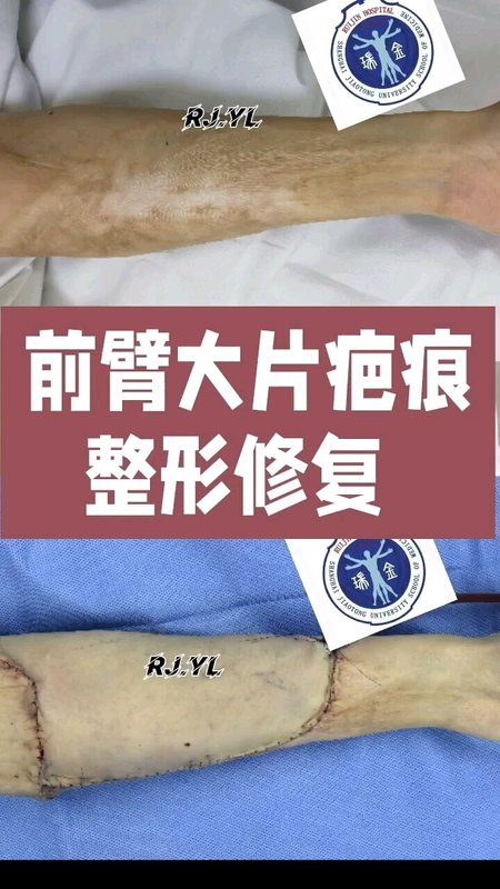 前臂大片疤痕如何去除？扩张器手术祛疤优势有哪些？