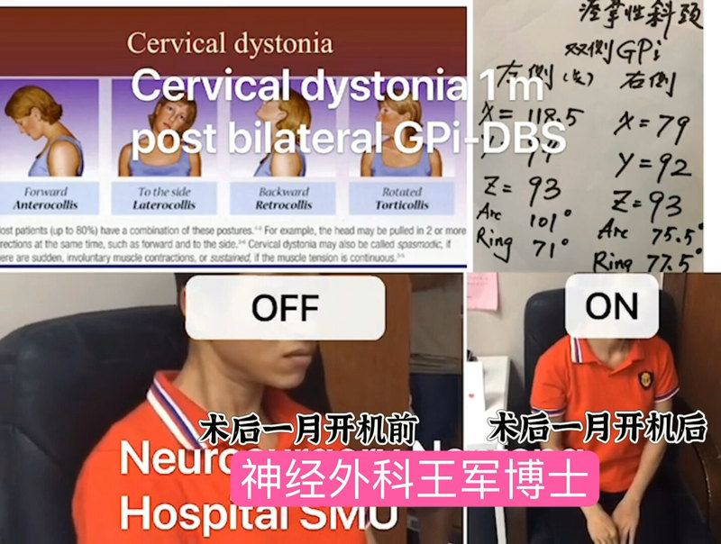 脑起搏器植入术治疗痉挛性斜颈术后5年