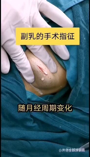 副乳什么时候需要手术治疗
