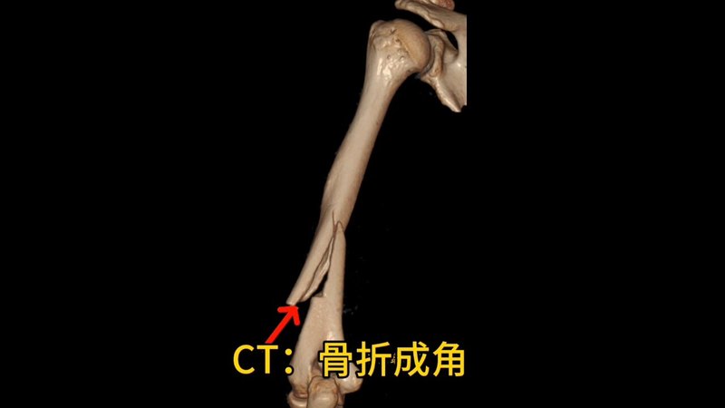 [骨折]科普第8集：肱骨粉碎性骨折，伴有移位明显，多以手术治疗，早期功能锻炼，尽早康复
