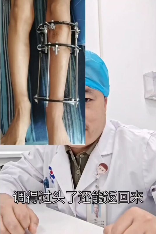 o型腿的手术原理