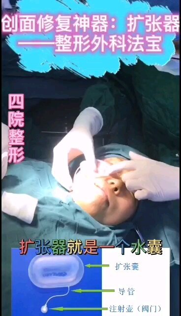 创面修复神器——扩张器
                    （整形外科法宝）
