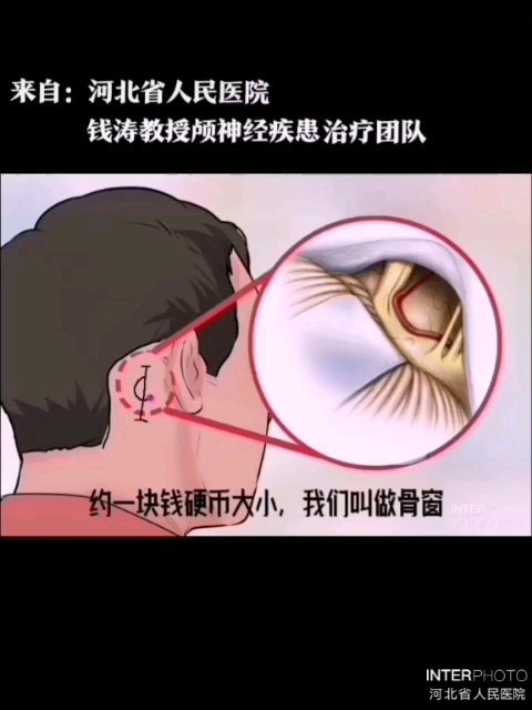显微血管减压术是怎样一个过程？