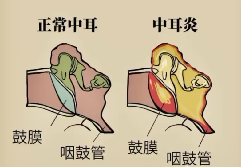 急性中耳炎诊断及治疗